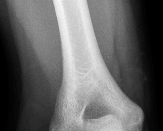 Illustration 35 for Master Diagnosis: Shoulder & Elbow Cases (Reproduced with Permission)