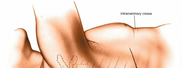 Illustration 308 for Approach to the Lumbar Spine: Mastering Techniques & Anatomy
