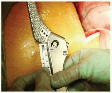 Illustration 15 for Why Polished Tapered Cemented Stems Excel in Hip Replacement