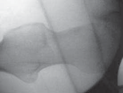 Illustration 32 for Resolving Femoral Head Neck Impingement: Arthroscopic FAI Solutions