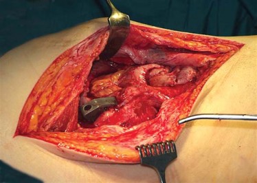 Illustration 9 for Optimizing Infected THA: The One Staged Approach Explained