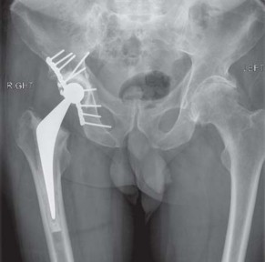 Illustration 59 for Navigating Early THA for Fractures of the Acetabulum