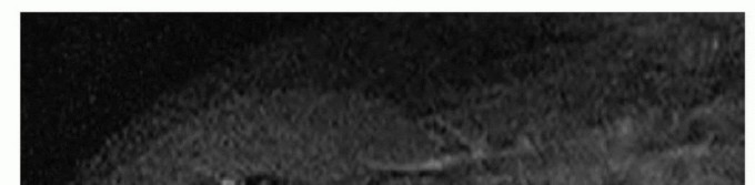 Illustration 8 for Is Your Dorsal Scapular Nerve Causing Snapping Scapula Pain?