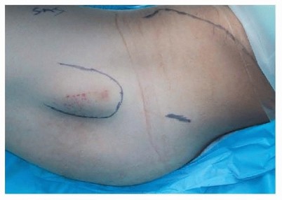 Illustration 20 for Is a Sliding Hip Screw Best for Your Femoral Neck Fracture?