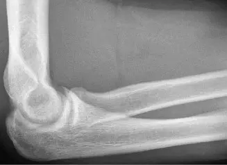 آلام المرفق الإنسية لدى الرياضيين: تشخيص شامل وعلاج متقدم على يد الأستاذ الدكتور محمد هطيف