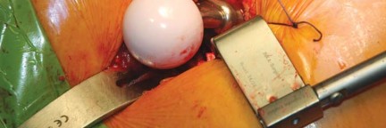 Illustration 57 for Kinectiv® Stem: Modular Necks for Primary THA Success