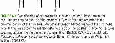 Illustration 11 for Periprosthetic Fractures: Causes, Risks, & Effective Treatment