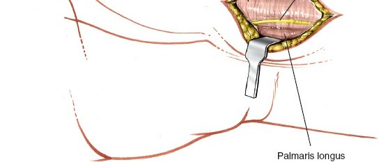 Illustration 185 for Essential Surgical Approaches: Uncover Every Aspect of the Wrist