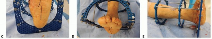 Illustration 27 for Regain Mobility: Surgical Solutions for Charcot Foot Arthropathy