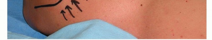 Illustration 17 for Is Your Dorsal Scapular Nerve Causing Snapping Scapula Pain?