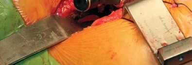 Illustration 49 for Kinectiv® Stem: Modular Necks for Primary THA Success