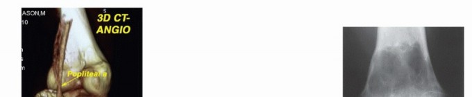 Illustration 18 for Understanding Benign Bone Tumors: Your Complete Preoperative Guide