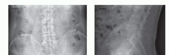 Illustration 14 for Sacral Tumor Surgery: Safeguarding Bowel & Bladder Control
