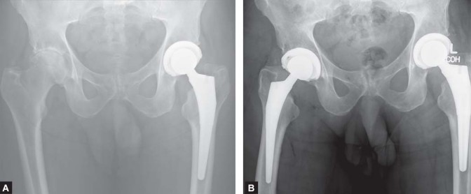 Illustration 12 for The Modified Hardinge Approach: Key Surgical Insights