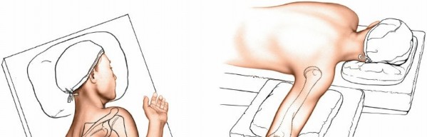 Illustration 31 for Mastering the Approach to the Distal Humerus: Safety & Skills