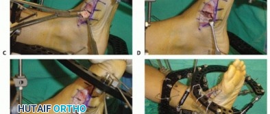 Illustration 64 for Mastering Midfoot Arthrodesis: Protect the Deep Neurovascular Bundle