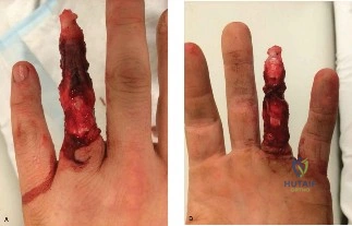 صورة توضيحية لـ إصابات اليد الخطيرة: تمزق الأنسجة (Degloving) والبتر الجزئي – دليل شامل للمرضى