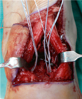 Illustration 39 for First Metatarsal Surgery: Expert Solutions for Foot & Ankle Pain