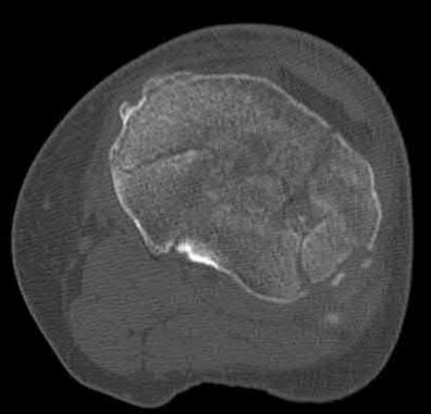 Illustration 185 for OrthoCash: Trauma MCQs & Cases for a yearold woman