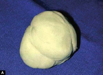 Illustration 17 for Optimizing Acetabular Component Cementation for Superior Outcomes