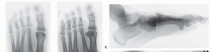 Illustration 4 for Fixation of Lisfranc Injuries: Essential Open Reduction Guide