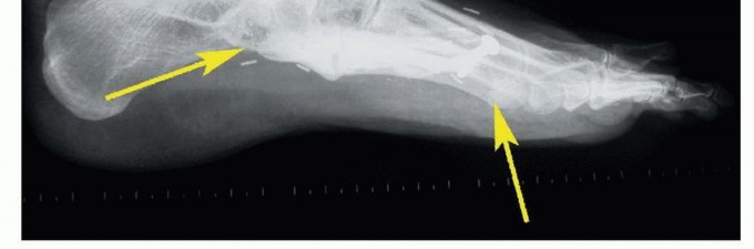 Illustration 31 for Treating Tumors of the Foot: Optimizing Amputation & Resection