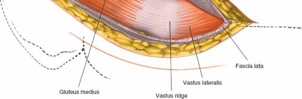 Illustration 106 for Unlocking Every Aspect of the Hip's Surgical Approaches