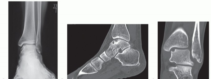 Illustration of talus perspective microfracture - Dr. Mohammed Hutaif