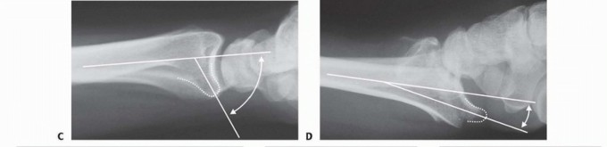Illustration 11 for Fragment-Specific Fixation: Restore Carpal Facet Horizon