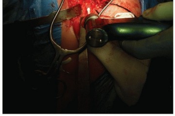 Illustration 19 for Cemented Acetabular Component: Achieving Optimal THA Stability