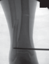 Illustration 39 for Optimal Nailing of the Tibia: Techniques for Challenging Fractures
