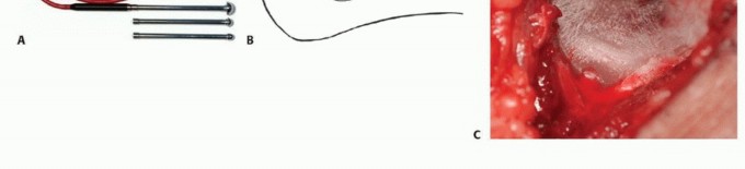 Illustration 14 for Avoid Major Surgery: Bone Tumor Treatment with Liquid Nitrogen Pour