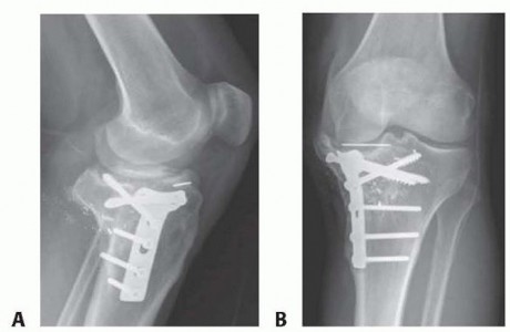 Illustration 2 for Achieve Lasting Pain Relief with Cemented Total Knee Arthroplasty