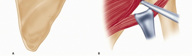 Illustration 31 for Mastering the Treatment of Recurrent Posterior Shoulder Instability