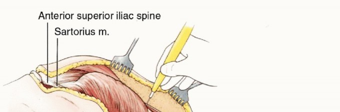 Illustration 20 for Anterior Flap Hemipelvectomy: Leveraging fig tech fig for Difficult Tumors