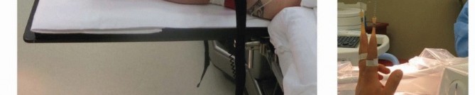 Illustration 18 for Galeazzi DRUJ Stabilization: Unlocking Stability with Smooth Stainless Steel