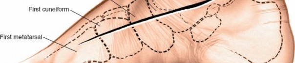 Illustration 183 for Optimized Approaches to the Dorsum of the Foot & Ankle