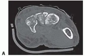 صورة توضيحية لـ كسور عظام الرسغ (ما عدا الزورقي): دليلك الشامل للتعافي على يد أفضل الخبراء في اليمن