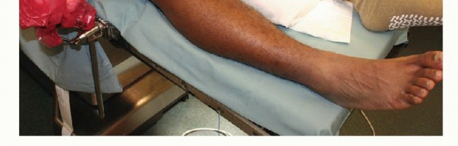 Illustration 8 for Symptomatic Knee? Meniscal Transplant for Anterior & Posterior Horns