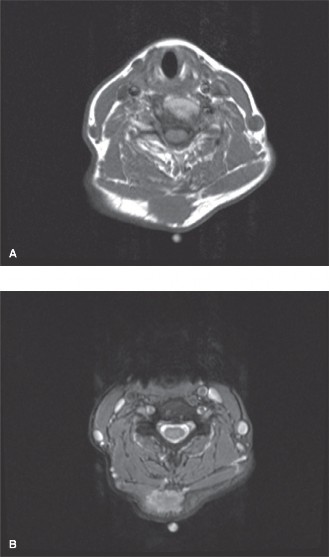 Illustration 1 for Solving Complex Orthopedic Oncology Cases Schwannoma