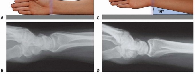 Illustration 9 for Fragment-Specific Fixation: Restore Carpal Facet Horizon