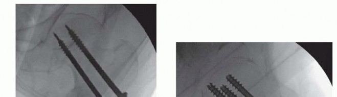 Illustration 12 for Is a Sliding Hip Screw Best for Your Femoral Neck Fracture?