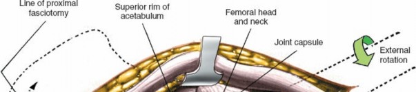 Illustration 121 for Unlocking Every Aspect of the Hip's Surgical Approaches