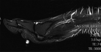 Illustration 2 for Medial and Lateral Foot Pain: Diagnosis & Imaging Insights