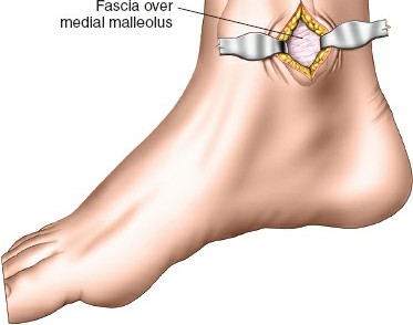 Illustration 67 for Surgical Access: Mastering the Tibia's Surface & Fibula Approaches