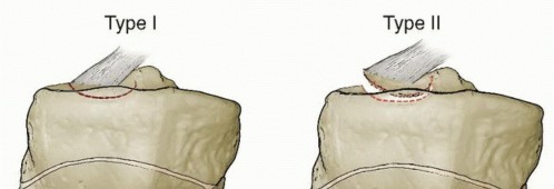 Treating Tibial Spine Fractures: Arthroscopy or Open Reduction?