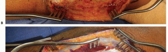 Illustration 21 for Optimal ORIF for Diaphyseal Forearm Fractures: Your Guide