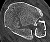 Illustration 14 for Decoding Pilon Fractures: Anterolateral and Medial Fragments Revealed