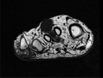 Illustration 2 for Unraveling Foot & Ankle Lumps: Is it Clear Cell Sarcoma?