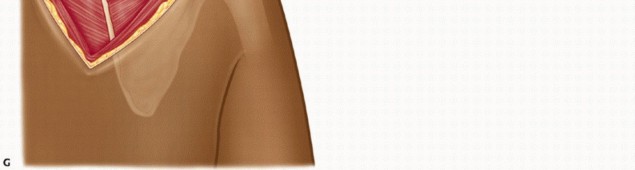 Illustration 19 for Snapping Scapula Syndrome: Why Your Shoulder Clicks & What to Do